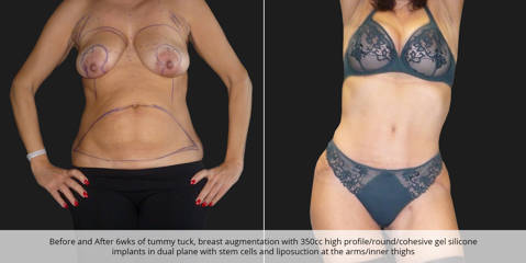 Before and after 6 weeks of tummy tuck, breast augmentation with 350cc silicone implants, and liposuction