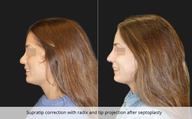 Side profile before and after septoplasty with supratip correction, radix refinement, and nasal tip projection