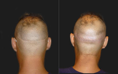 Before and after hair transplantation showing increased scalp hair density and restored bald area coverage