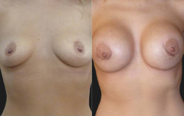 Before and after breast augmentation showing enhanced symmetry and fuller contour