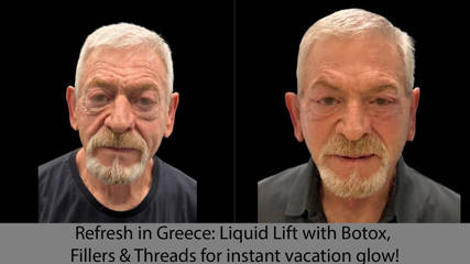 Refresh in Greece: Liquid Lift with Botox, Fillers & Threads for instant vacation glow!