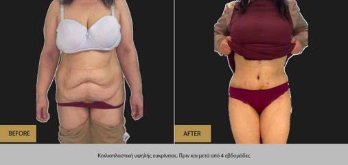 Before and after high definition abdominoplasty showing enhanced waistline and sculpted abdomen