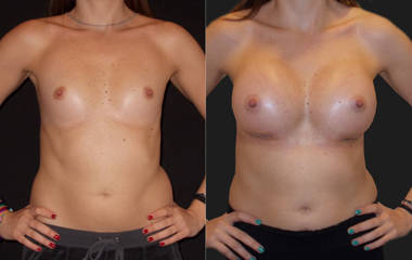 Before and after breast augmentation showing enhanced volume and improved breast contour