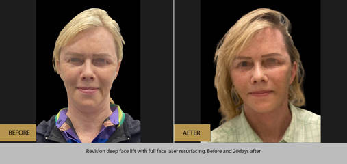 Before and after photos of woman following revision deep face lift and full face laser resurfacing