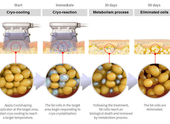 Illustration showing the cryolipolysis process
