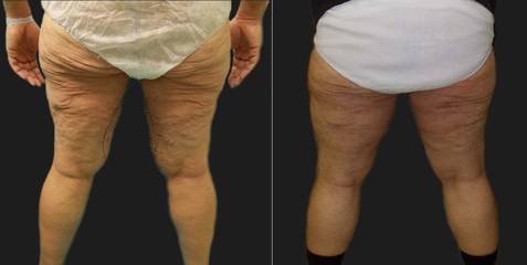 Before and after inner thigh lift showing removal of sagging skin and smoother thigh contour
