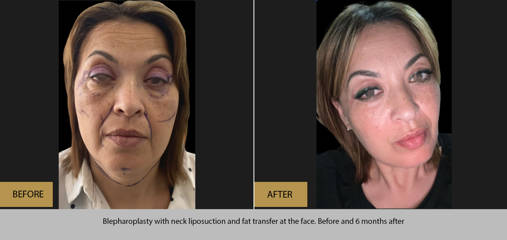 Before and 6 months after blepharoplasty with neck liposuction and fat transfer
