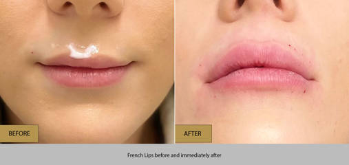 Before and immediately after French lip filler treatment showing elegant, softly defined lips