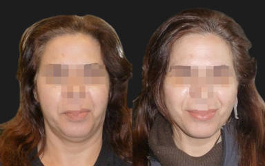 Before and after full facelift showing refined jawline, improved neck contour and refreshed overall facial appearance