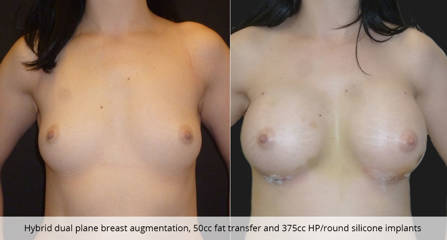 Before and after hybrid dual plane breast augmentation, 50cc fat transfer and 375cc HP/round silicone implants