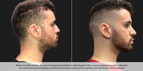 Male profile before and 4 weeks after open rhinoplasty with dorsal hump removal and tip refinement
