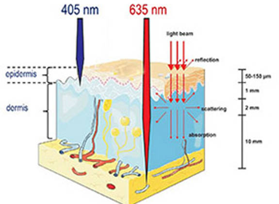 Illustration showing how 405 nm and 635 nm light wavelengths penetrate skin layers in photodynamic therapy