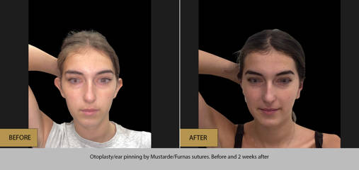 Before and 2 weeks after otoplasty/ ear pinning by Mustarde and Furnas sutures
