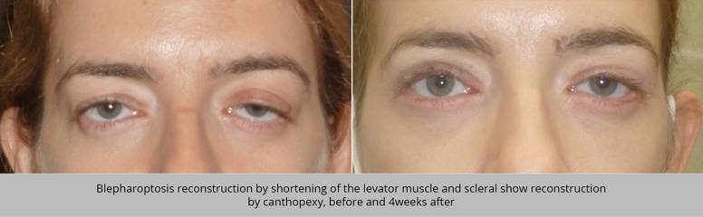 Before and after blepharoptosis correction with levator muscle shortening and scleral reconstruction 