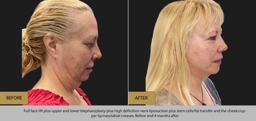 Before and 4 months after full facelift, upper and lower blepharoplasty and high definition neck liposuction