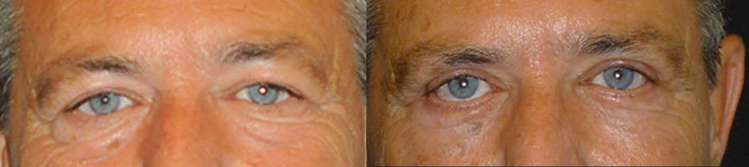 Upper and lower blepharoplasty showing smoother eyelids and reduced wrinkles, before and after surgery