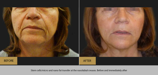 Before and after of stem cells, micro and nano transfer at the nasolabial creases