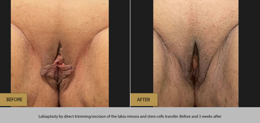 Labiaplasty by direct trimming/ excision of the labia minora and stem cells transfer, before and 3 weeks after