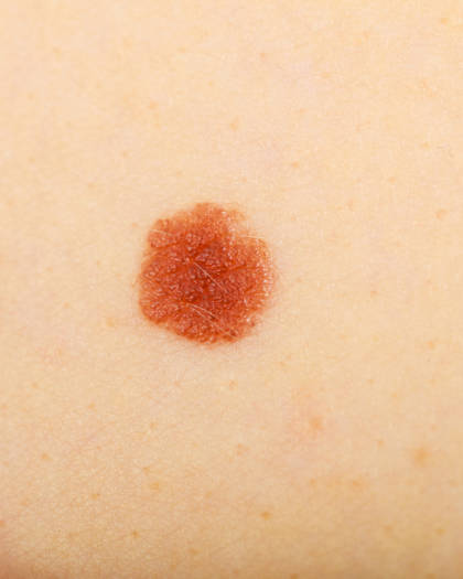 Close up of a brown mole on light skin, used to illustrate skin examination of early signs of skin cancer