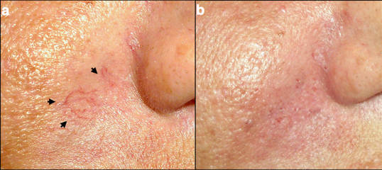 Before and after laser spider vein treatment on facial skin