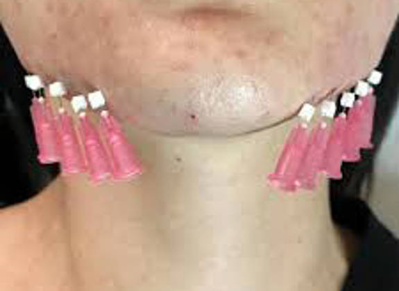 Close up of lower face showing multiple pink threads inserted along the jawline during a thread face lift procedure