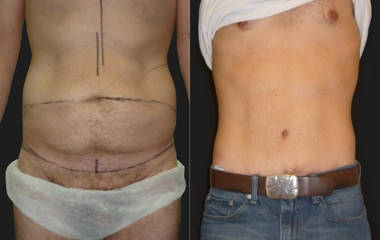 Male high-definition abdominoplasty before and after surgery showing removal of excess skin and fat