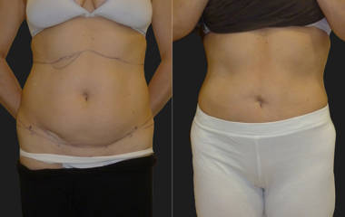 Before and after abdominal liposuction showing flatter stomach and improved contour