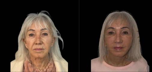 Scarless Face Lift 12