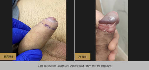 Before and after micro-circumcision showing postoperative healing and aesthetic outcome