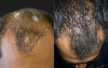 Before and after male hair transplantation showing improved hair density and full frontal coverage
