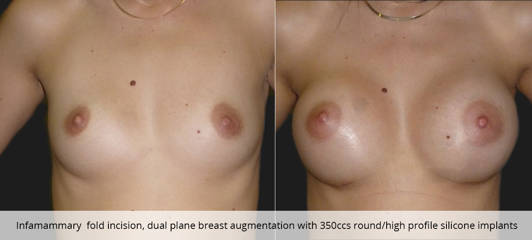 Infamammary fold incision, dual plane breast augmentation with 350ccs round/ high profile silicone implants
