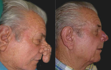 Before and after nasal tumor removal and reconstructive surgery showing restored nasal structure