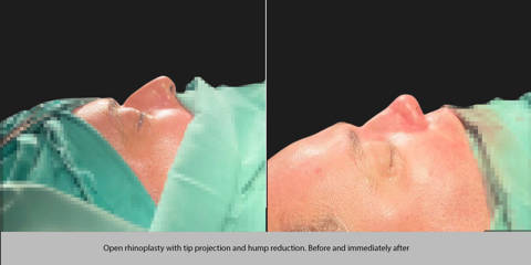 Side view, before and after open rhinoplasty with tip projection and hump reduction