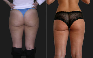 Liposuction19