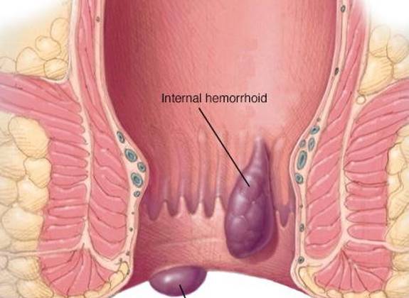 Illustration showing internal and external hemorrhoids in the anal canal, highlighting their structure
