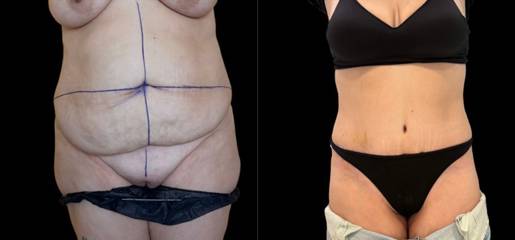 Abdominoplasty 26