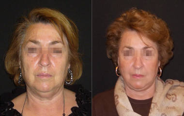 Before and after facelift showing improved jawline, neck contour and smoother lower-face appearance