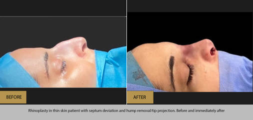 Side view before and after rhinoplasty in thin skin patient correction septum deviation and dorsal hump