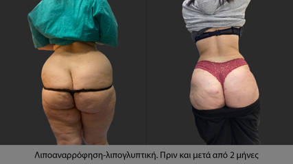 Liposuction 64