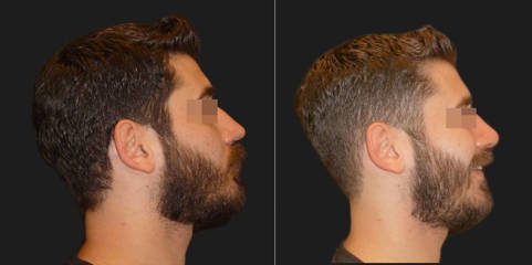Male profile before and after rhinoplasty, showing straighter nasal bridge and improved profile