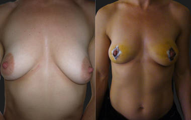 Before and after breast lift showing improved contour and nipple repositioning