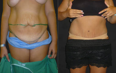 Before and after abdominoplasty showing flatter abdomen and refined waistline