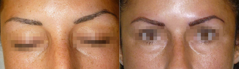 Before and after of eyebrow micropigmentation treatment showing pigment application for fuller brows