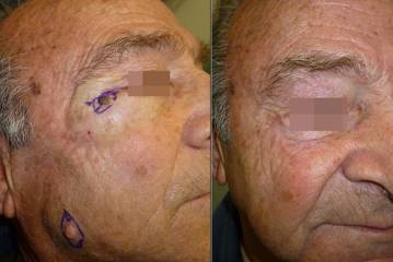 Before and after removal and reconstruction of a skin lesion near the lower eyelid with natural post surgical healing