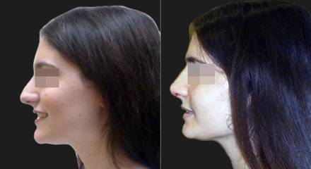 Female profile before and immediately after rhinoplasty with visible improvement to nose shape and post-op dressing