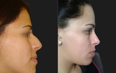 Female profile before and after rhinoplasty with nasal hump reduction and tip refinement