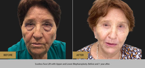 Before and one year after scarless face lift with upper and lower blepharoplasty
