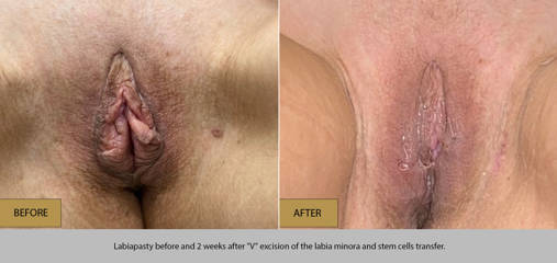 Labiaplasty before and 2 weeks after V excision of the labia minora and stem cells transfrer