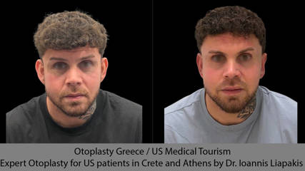 Ωτοπλαστική στην Ελλάδα / Ιατρικός Τουρισμός από τις ΗΠΑ. Εξειδικευμένη ωτοπλαστική για ασθενείς από τις ΗΠΑ στην Κρήτη και την Αθήνα από τον Δρ. Ιωάννη Λιαπάκη.