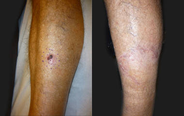 Before and after removal and healing of a skin lesion on the lower leg, with smooth scar formation after recovery